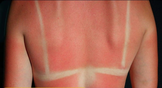 Remember: Even a hint of pink is a sign of skin damage. ☀️